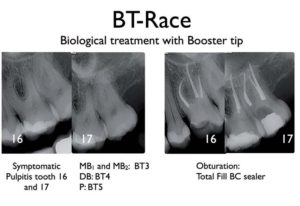 1Biological and conservative root canal instrumentation with BT-Race file system