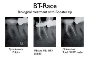 2Biological and conservative root canal instrumentation with BT-Race file system