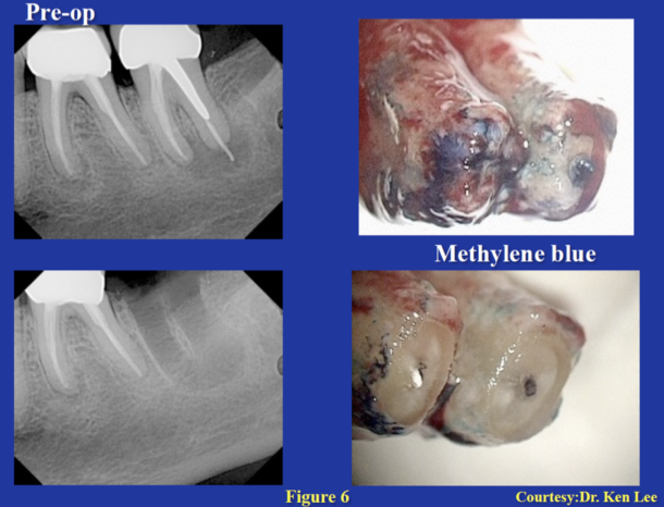 Intentional Replantation | Next Level Endodontics