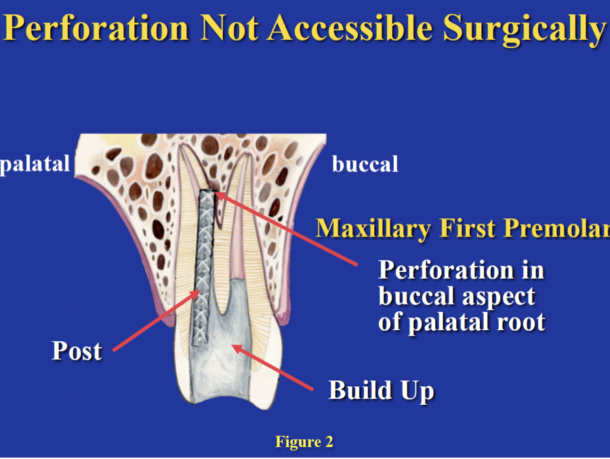 Intentional Replantation | Next Level Endodontics