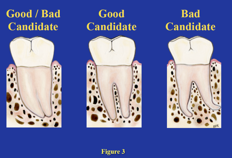 Intentional Replantation | Next Level Endodontics