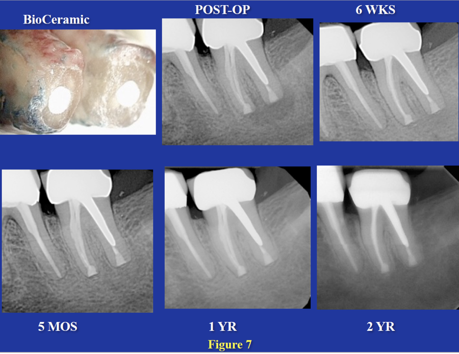 Intentional Replantation | Next Level Endodontics