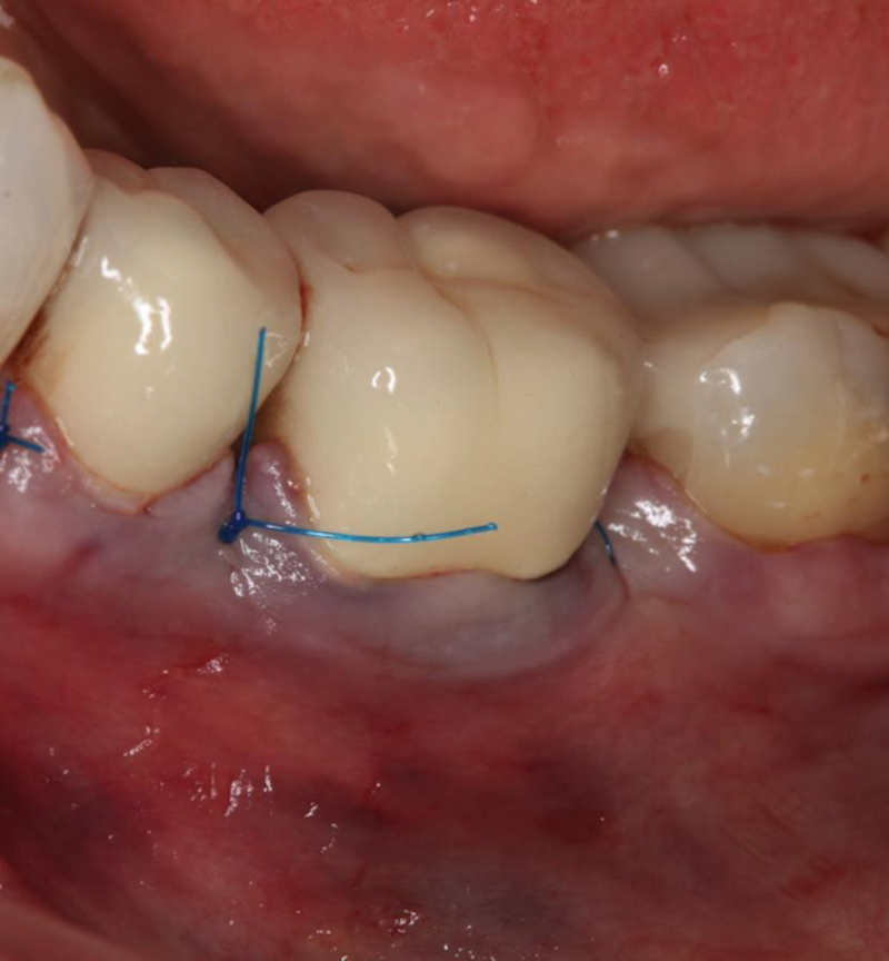 highfive endodontics